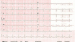 Abb. 6: EKG