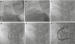 Abb. 5a-f: Angiogramm