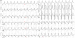 Abb. 1: EKG