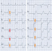 Abb. 1: EKG