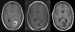 Abb. 3: Gliomchirurgie