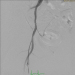 Abb. 1: Diffus atherosklerotisches Gef