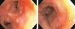 Aktuelles Bild - Abb. 3: Bronchoskopie