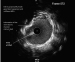 Abb. 17: IVUS