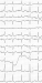 Abb. 2: EKG