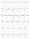 Abb. 3: EKG