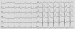 Abb. 2: EKG