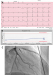 Abb. 6: Instabile Angina pectoris - Print-Abbildung 1