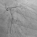Abb. 1: Koronarangiographie - CX