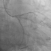 Aktuelles Bild - Abb. 3: Kissing-PTCA LM/OM/CX 