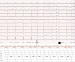 Abb. 2: EKG