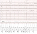 Abb. 3: EKG