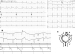 Abb. 4: EKG