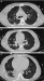 Abb. 4A-C: Thorax-CT