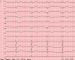 Abb. 1: EKG bei der Aufnahme
