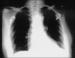 Fig. 1: Lungeninfiltrat
