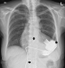 Aktuelles Bild - Abb. 1: Thorax-Rntgen