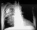 Fig. 2: Lungeninfiltrat