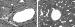 Fig. 1: Nephrektomie - Wandverdickung