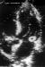 Fig. 1: Endokarditis - Diagnose - TEE