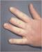 Abb. 2: Raynaud-Phnomen