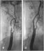 Abb. 1a-b: ACI-Stenose - Stent