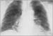 Abb. 7: Raynaud-Phnomen