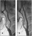 Abb. 2a-b: ACI-Stenose - Stent