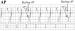 Abb. 1: Schrittmacher - AV Conduction