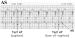 Abb. 2: Schrittmacher - Atrial Chamber Reset