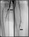 Abb. 2: Arteria femoralis superficialis - Stent