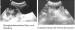 Abb. 2: Colitis - Diarrhoe