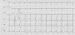 Aktuelles Bild - Abb. 1: AV-Knoten - Suppression