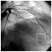 Fig. 1: R. interventricularis anterior - Stenose