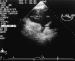 Fig. 1: Rechtsatrialer Appendix