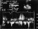 This Image - Fig. 3: Rechtsatrialer Appendix