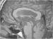 Abb. 2: Hydrozephalus beim Erwachsenen