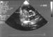 Fig. 1: Atriales Myxom