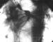 Fig. 1: Koronare Anomalie