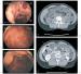 Aktuelles Bild - Abb. 1a-e: Pneumotosis cystoides intestinalis