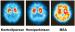 Abb. 4: Morbus Parkinson - SPECT