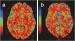 Abb. 4: MSA - Diffusion weighted imaging