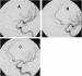 Abb. 7: Aneurysma - Papaverin - Ballon-Angioplastie