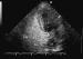 Abb. 5: Interatriales Septum - Aneurysma