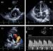 Aktuelles Bild - Abb. 1a-d: Transthorakale Echokardiographie