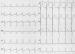 Aktuelles Bild - Abb. 1: Linksherzhypertrophie