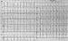 Abb. 1: Subakute Stentthrombose - Fallbericht
