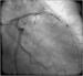 Aktuelles Bild - Abb. 4: Subakute Stentthrombose - Fallbericht