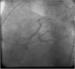 Abb. 5: Subakute Stentthrombose - Fallbericht