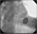 Aktuelles Bild - Abb. 8: Subakute Stentthrombose - Fallbericht